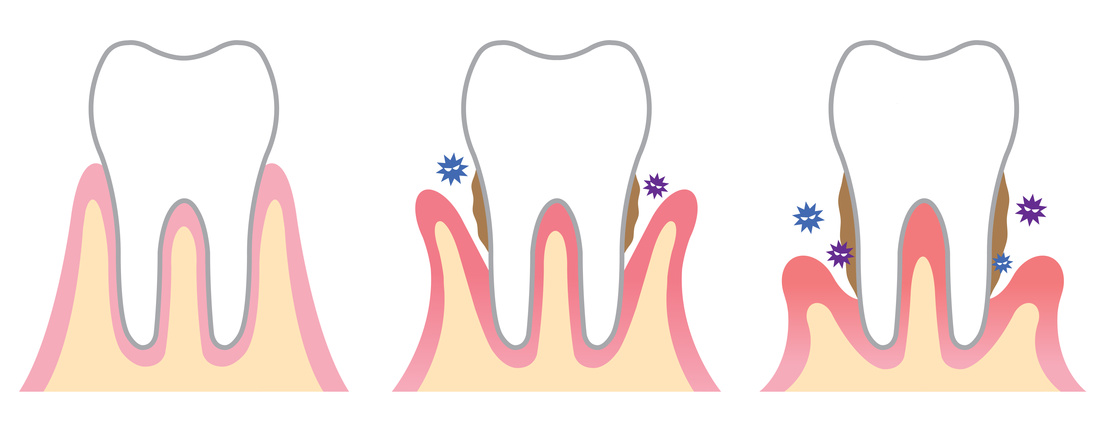 Stadien einer Parodontitis