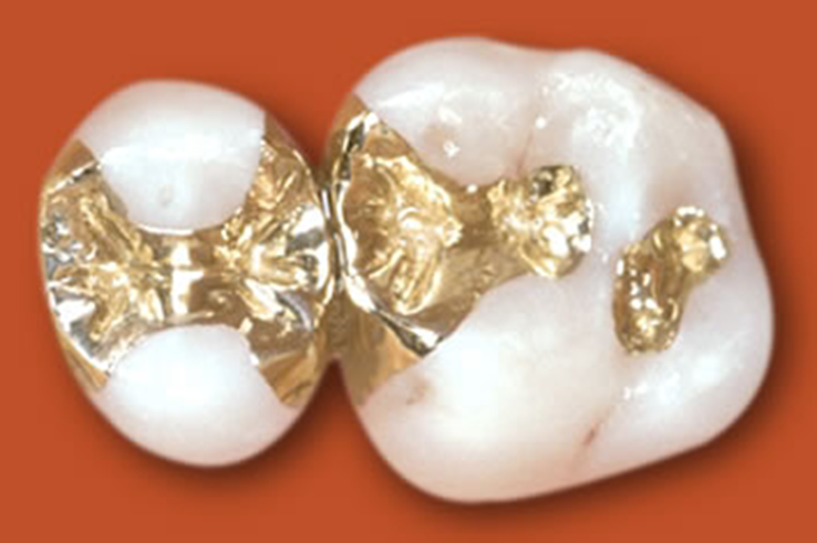Präzise gefertigte Goldfüllungen auf Backenzähnen, ein Beispiel für hochwertigen Zahnersatz von Kollmar.