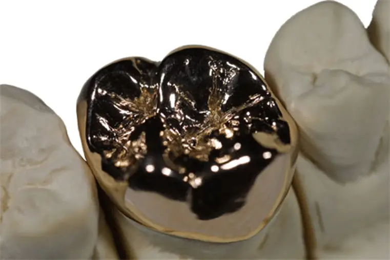 Hochwertige Goldkrone auf einem Gipsmodell zur Demonstration von langlebigem Zahnersatz aus dem Meisterlabor.