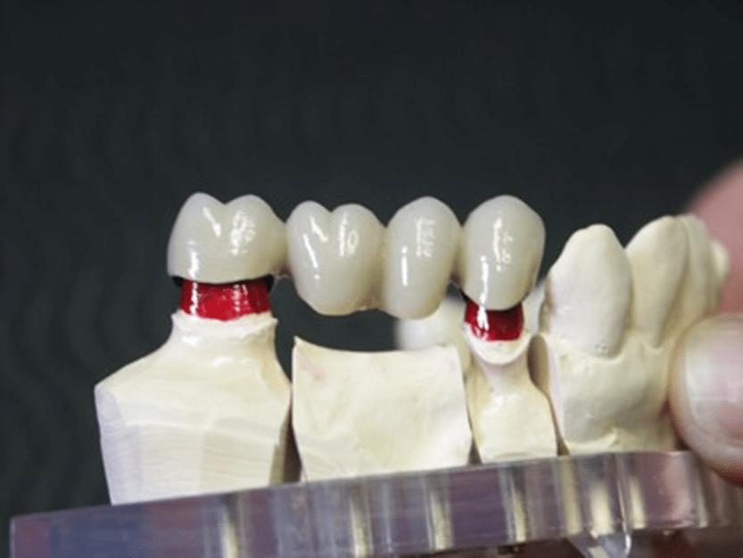 Modell einer stabilen Vollkeramikbrücke, die als metallfreie Lösung beim Zahnarzt zur Schließung von Zahnlücken dient.