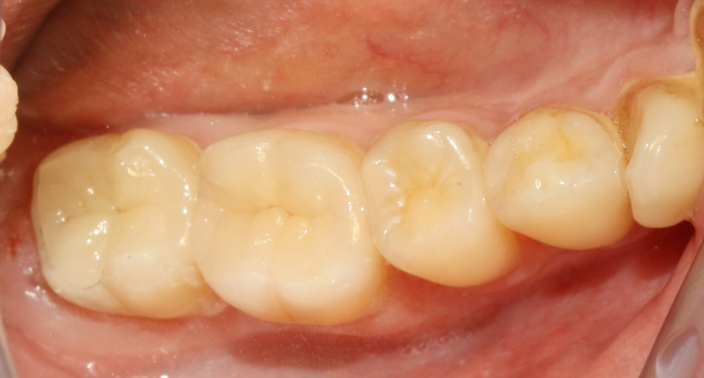 Perfekt sitzende, ästhetische Keramikinlays nach dem Einsetzen – natürliches Erscheinungsbild der Backenzähne.
