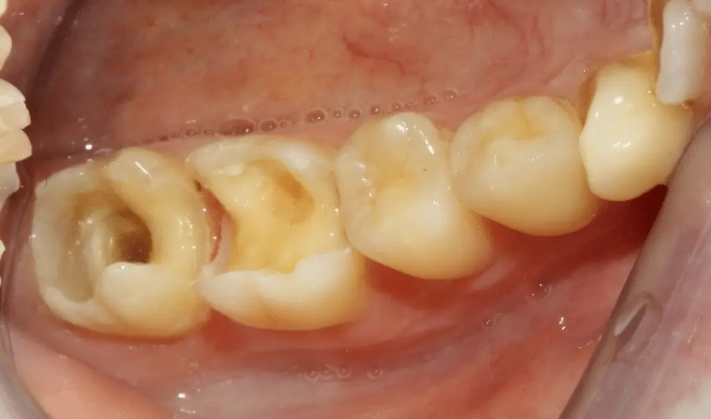 Vorbereitete Backenzähne vor dem Einsetzen von hochwertigen Keramikinlays in der Zahnarztpraxis Kassel.