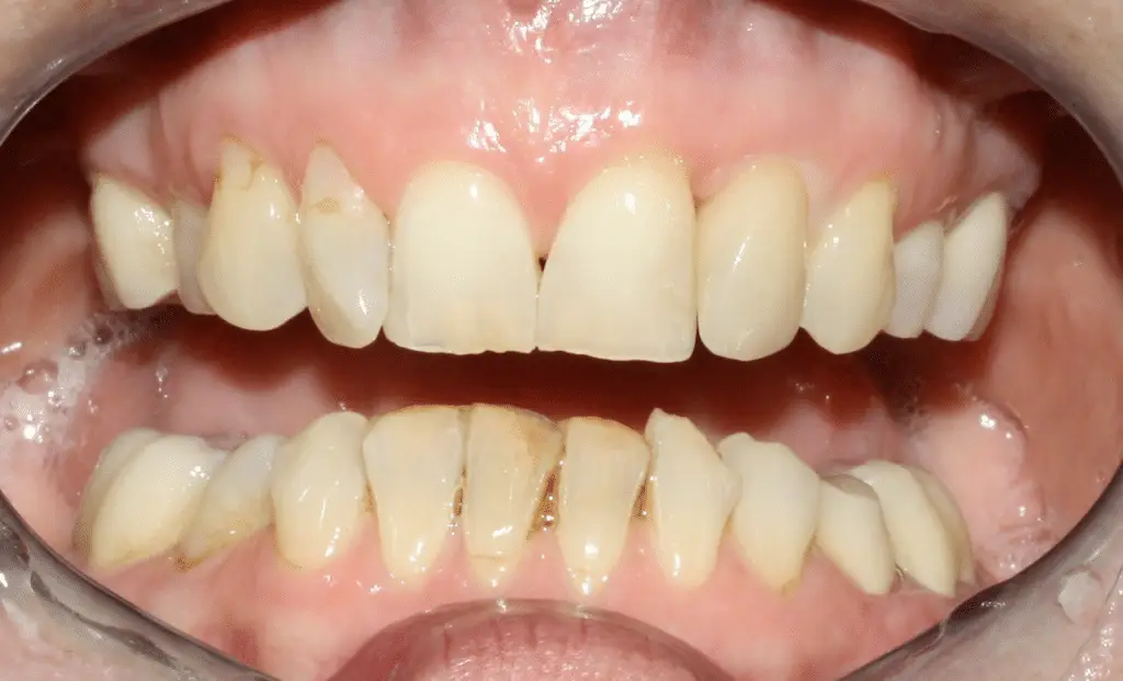 Ergebnis nach der Behandlung: Natürliches Lächeln durch eine perfekt angepasste Vollkeramikkrone im Oberkiefer.